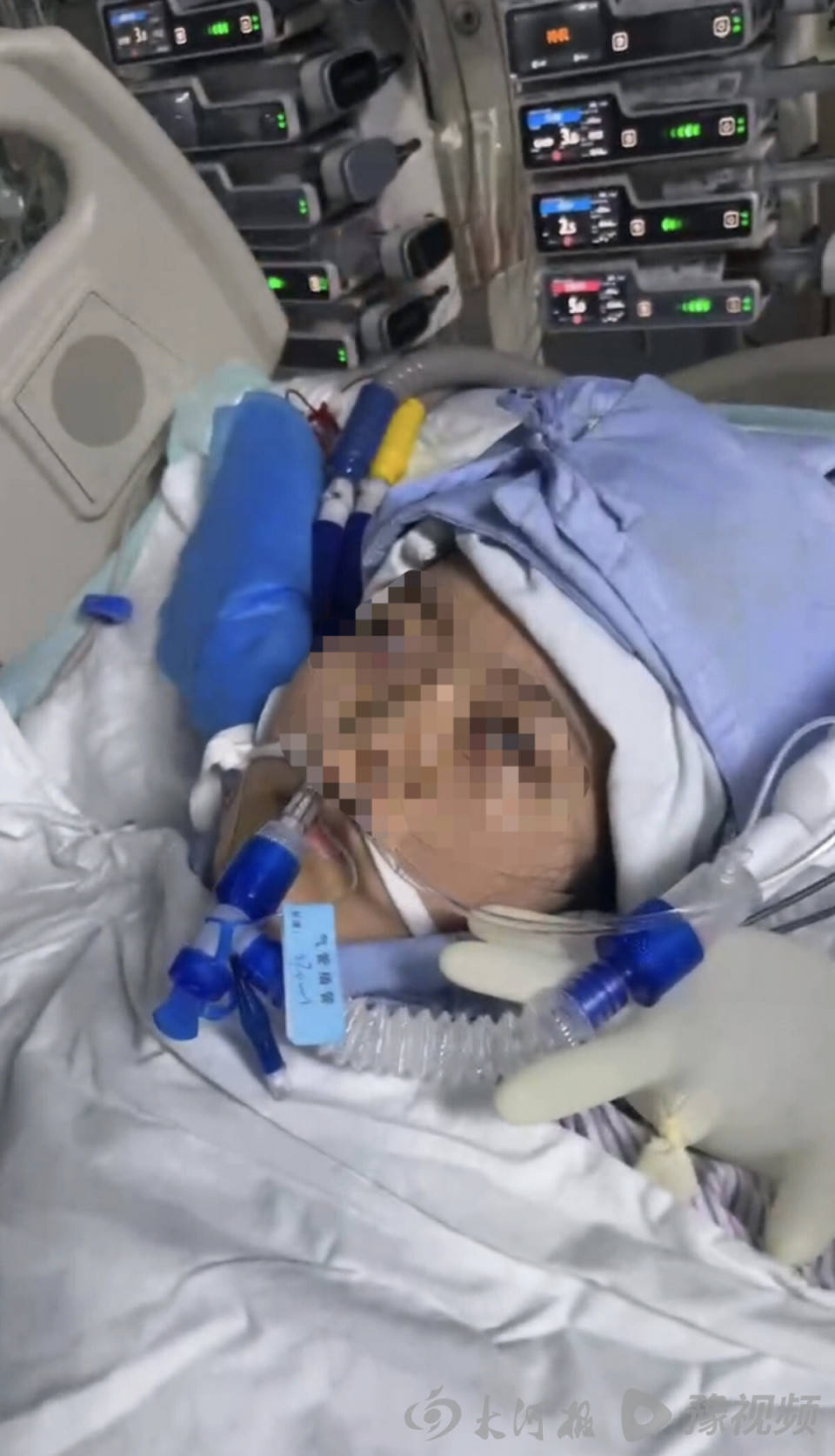 22岁美甲师手术成功却在复苏室脑死亡，家属称缺氧30分钟监护医生未察觉，医院回应